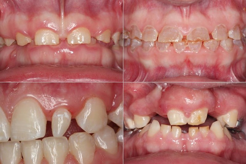 Various Congenital Dental Defects