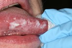 Oral Cancer