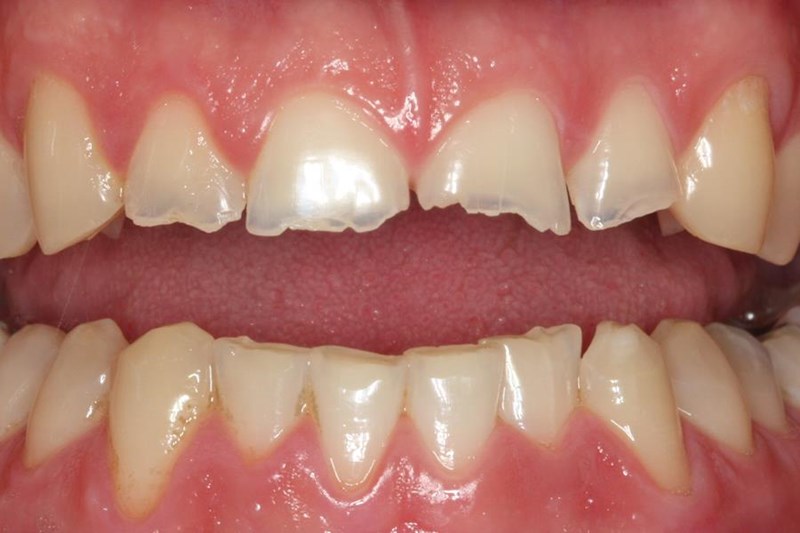 Broken Tooth/Teeth American College of Prosthodontists