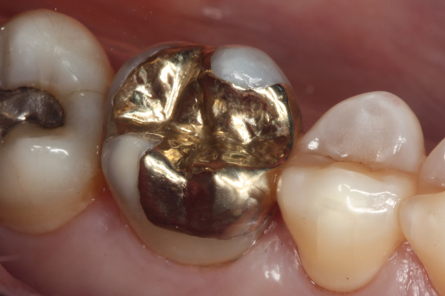 Gold dental onlay on a back molar