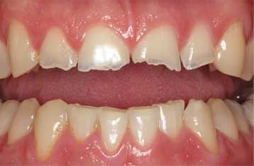 Broken teeth as a result of bruxism, aka teeth grinding