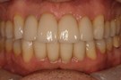 Porcelain Crowns for a Happier Smile