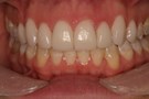 Improved Colors with Veneers