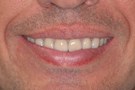 Severely Worn Teeth