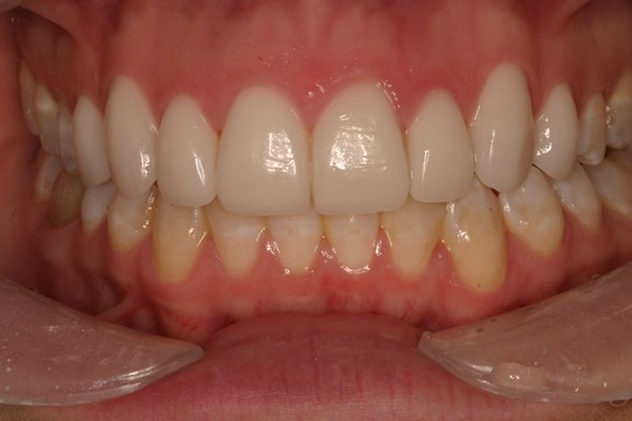 rawdin-veneers-after