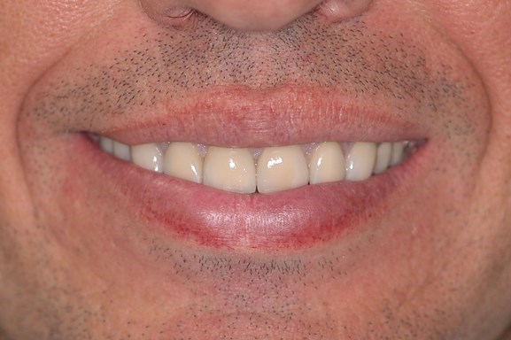 severely-worn-teeth-cover