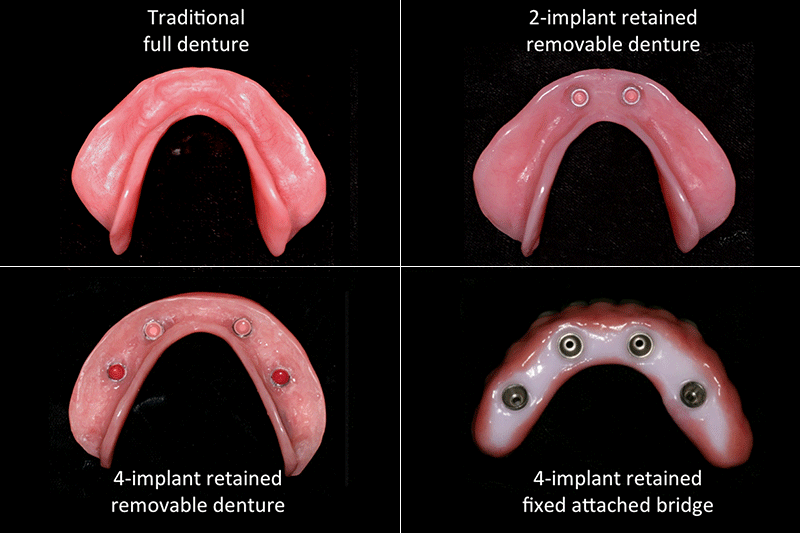 Lower_Missing_Teeth_(Bidra)