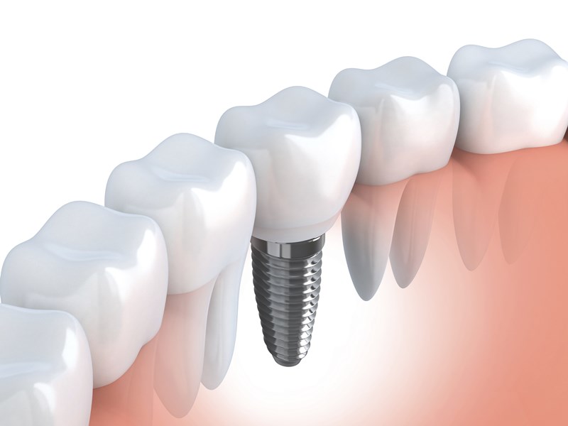 DentalImplants_ThinkstockPhotos-493611999