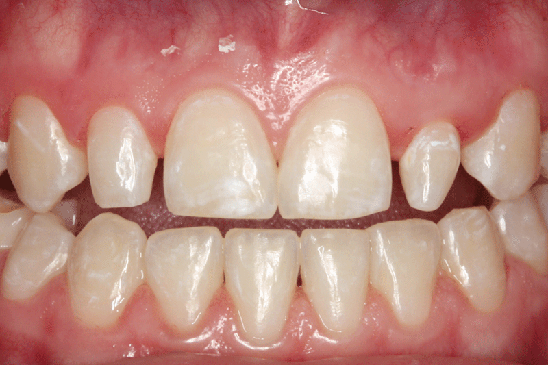 Misshapen Teeth