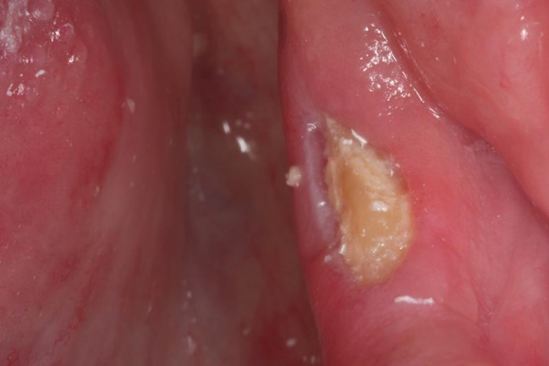 Osteonecrosis in a patients mouth