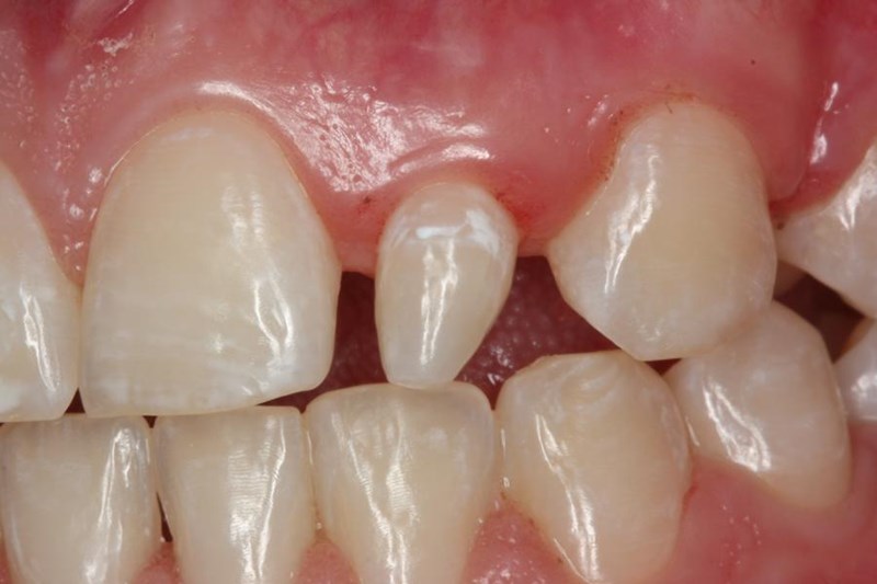 Peg Lateral Incisors | American College of Prosthodontists