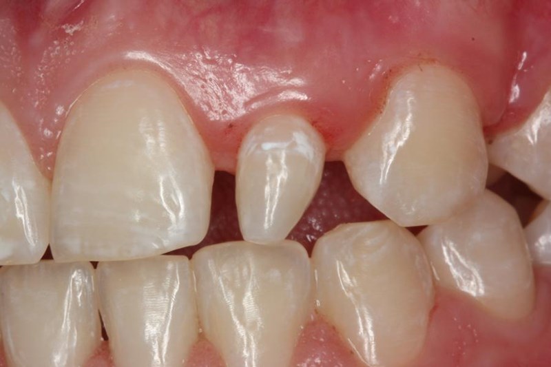 A Peg Lateral Incisor