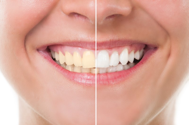 Teeth whitening before and after