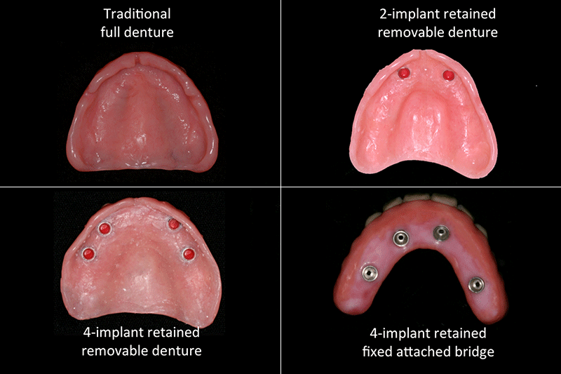 Dentures For 2 Missing Teeth . Wearing Dentures For The First Time Requires Some Adjustments To Your.